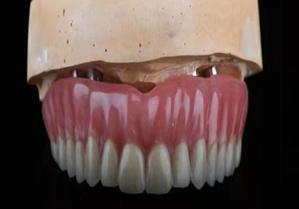 個性化基台+聚合瓷覆蓋義齒